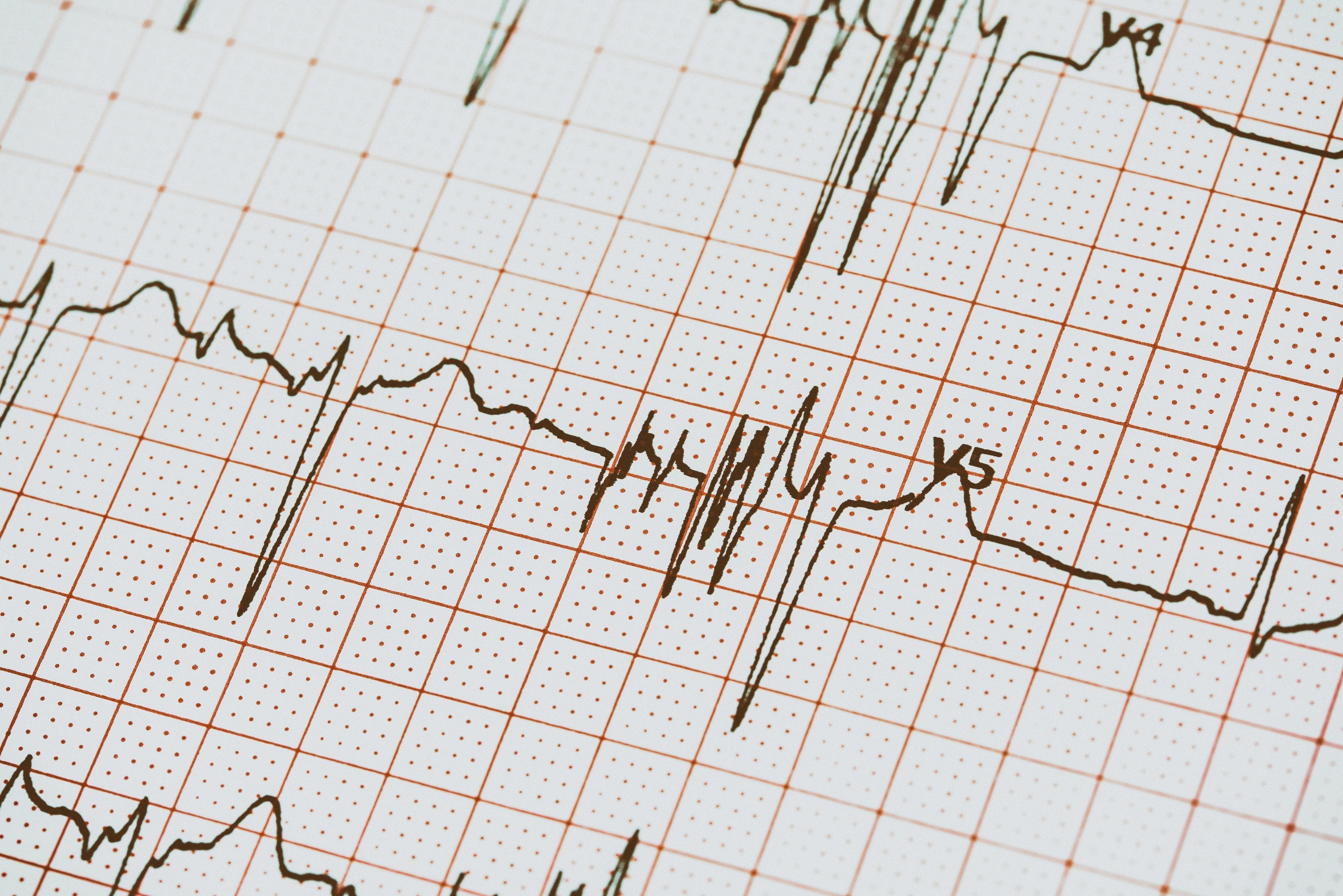 What are Electrocardiograms? Everything You Need to Know About ECG.