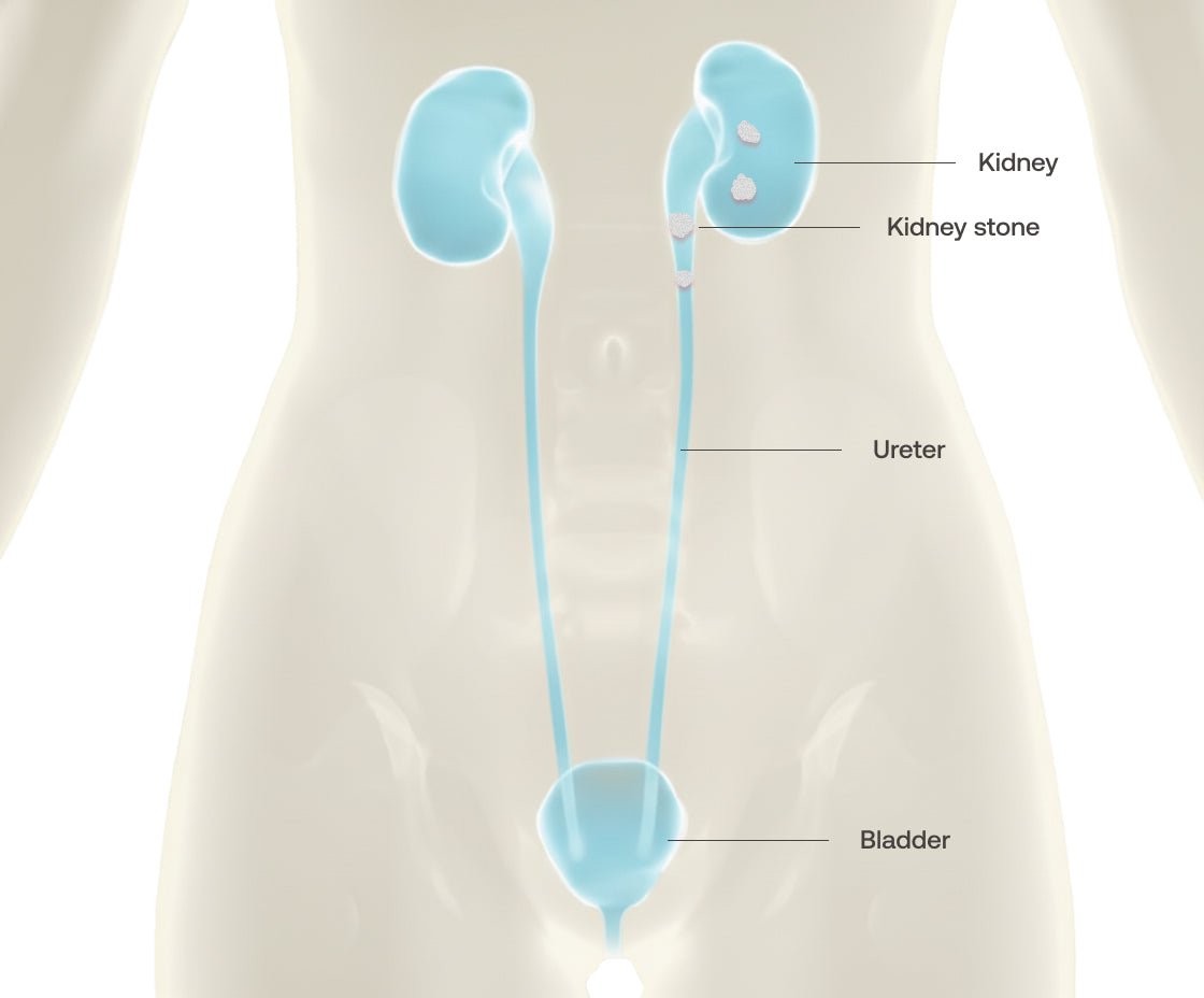 can glp-1 cause kidney stones GLP1 medications increase stone risk? A UAB urologist offers insight Can Semaglutide Cause Kidney Stones?