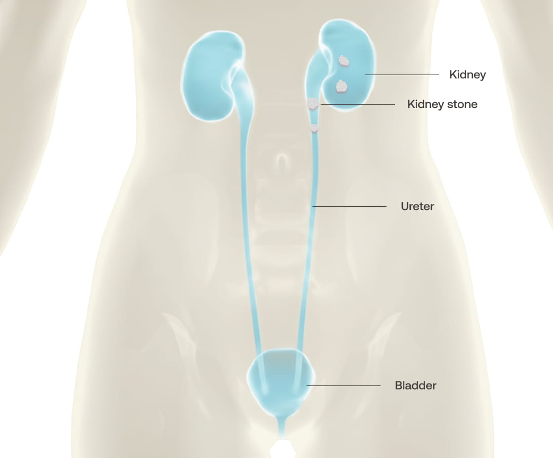 do glp 1 cause kidney stones Weight Loss Injections Stones? Evidence and Guidance GLP-1 agonists in the treatment